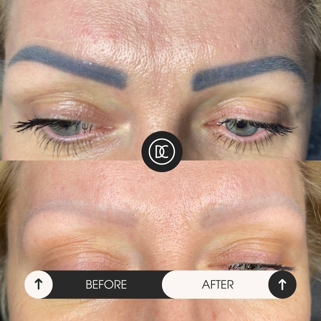 До видалення тату